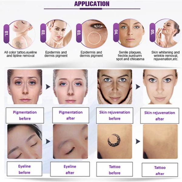 532nm 1064nm 1320nm Q Switch Nd Yag Mini Sapphire Ruby Laser Tattoo Removal Machine