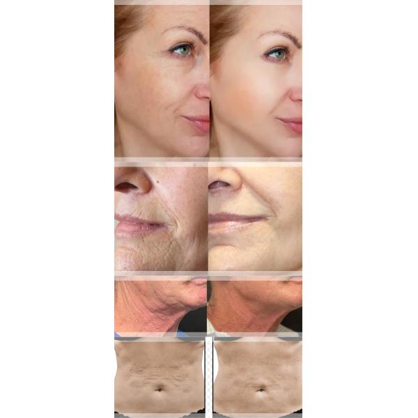 Portable Morpheus 8 Fractional Machine Rf Microneedle Fractional Rf Microneeding Machine