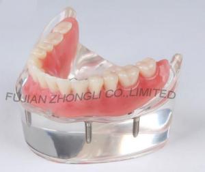 Quality dental 4 impants hybrid denture combination lower arch model for sale