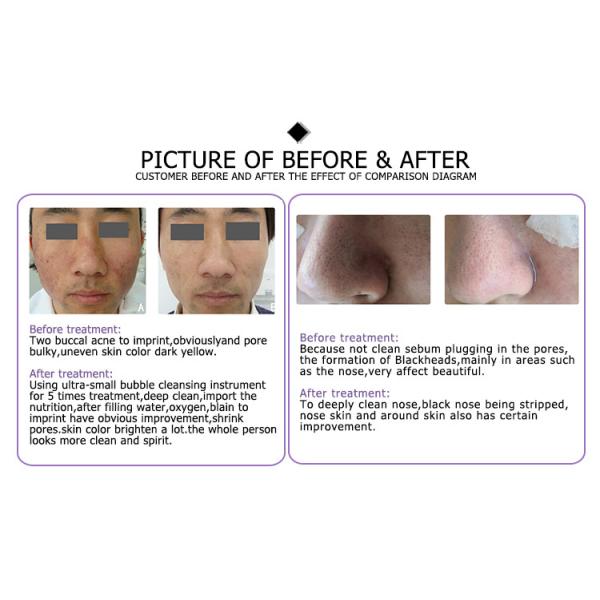 2021 best replacement water synergy handheld roller flex tips md hydrafacial machine from koreajavascript:void(0);