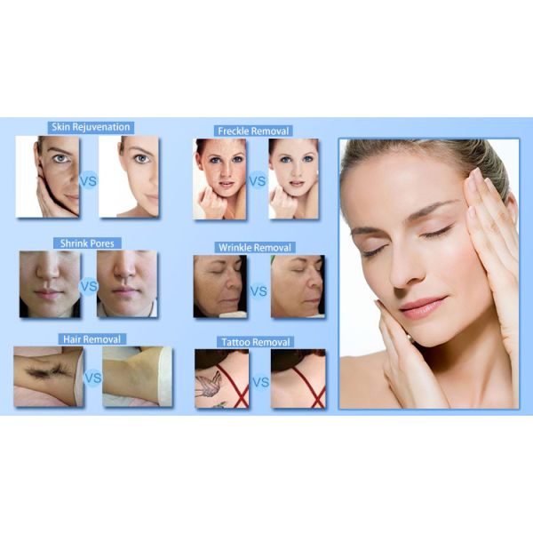 OPT SHR IPL RF Machine 4 in 1 1064nm Wavelength Bipolar RF Technology