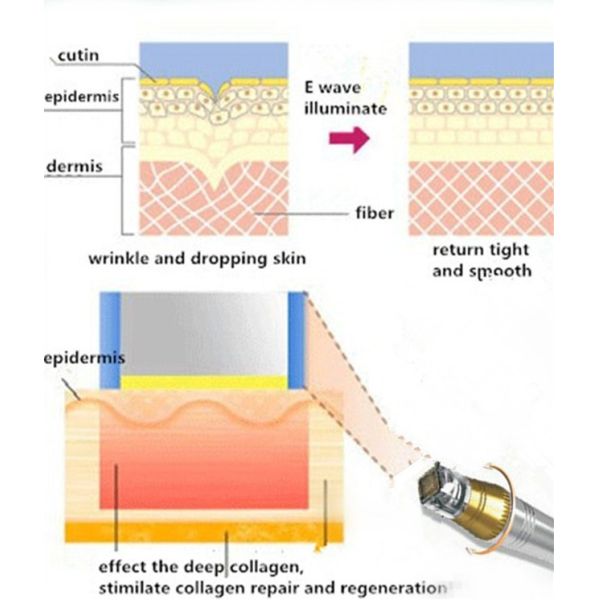 Microcomputer micro needle fractional rf machine