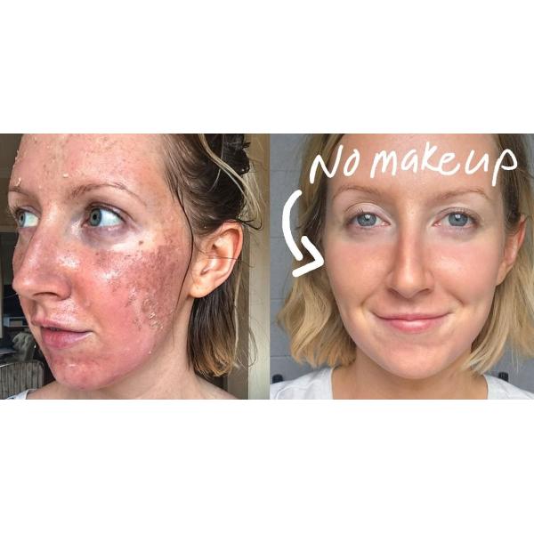 40w Vertical Lcd Co2 Laser Vaginal Machine 240vac