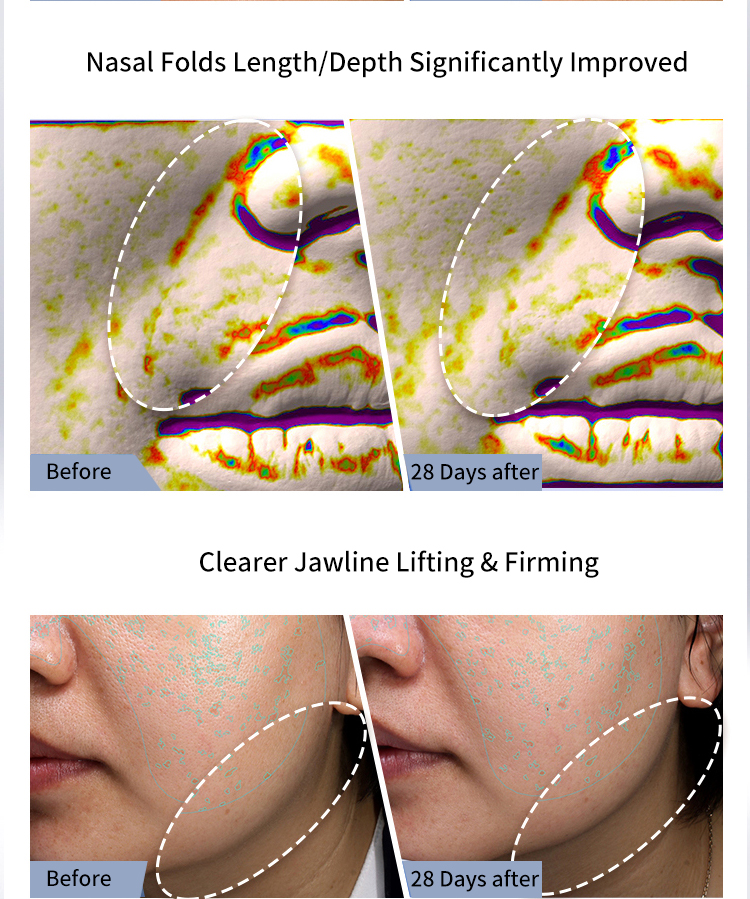 Personal Care Grooming Skin Rejuvenation Device Facial Lifting Firming